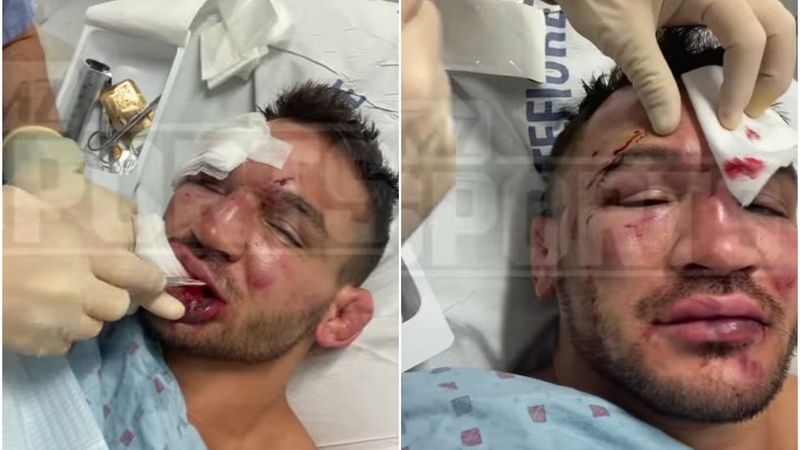 Чандлър с 22 шева на лицето след загубата от Гейджи