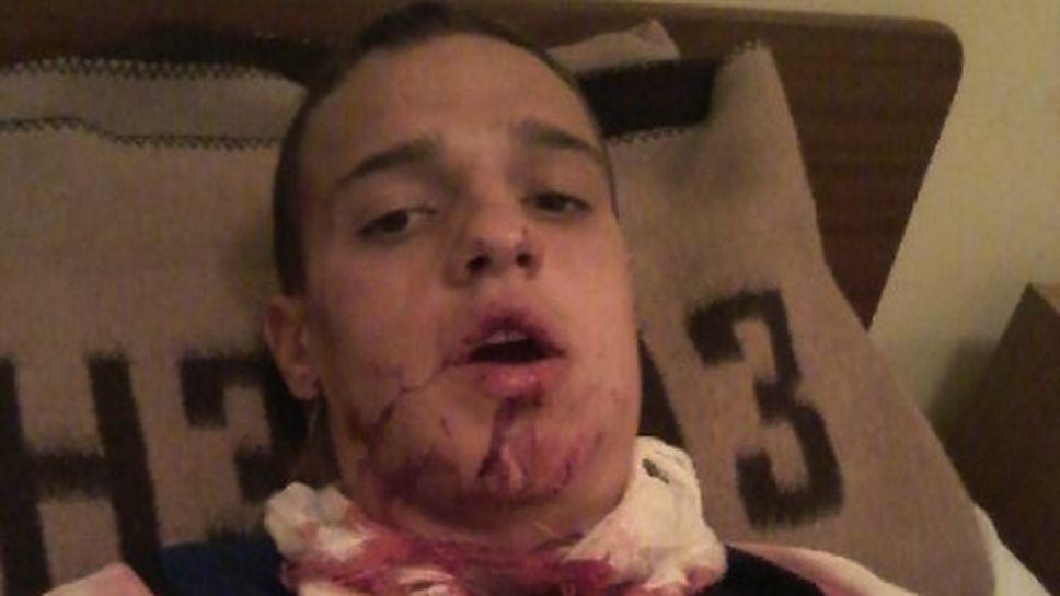 Футболист от "Б" група със счупена челюст на три места след брутален шут в главата (снимки)