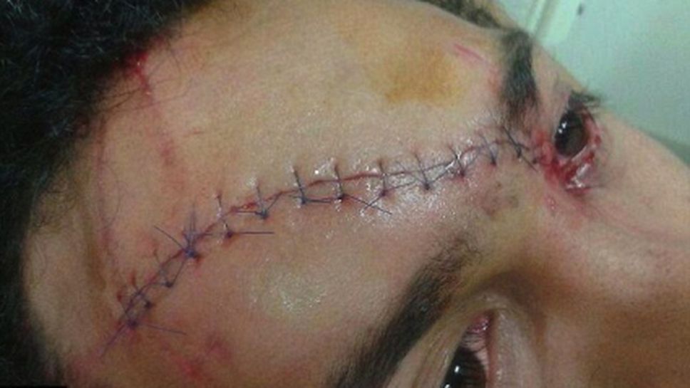 Зашиха с 13 шева челото на звезда в ръгбито