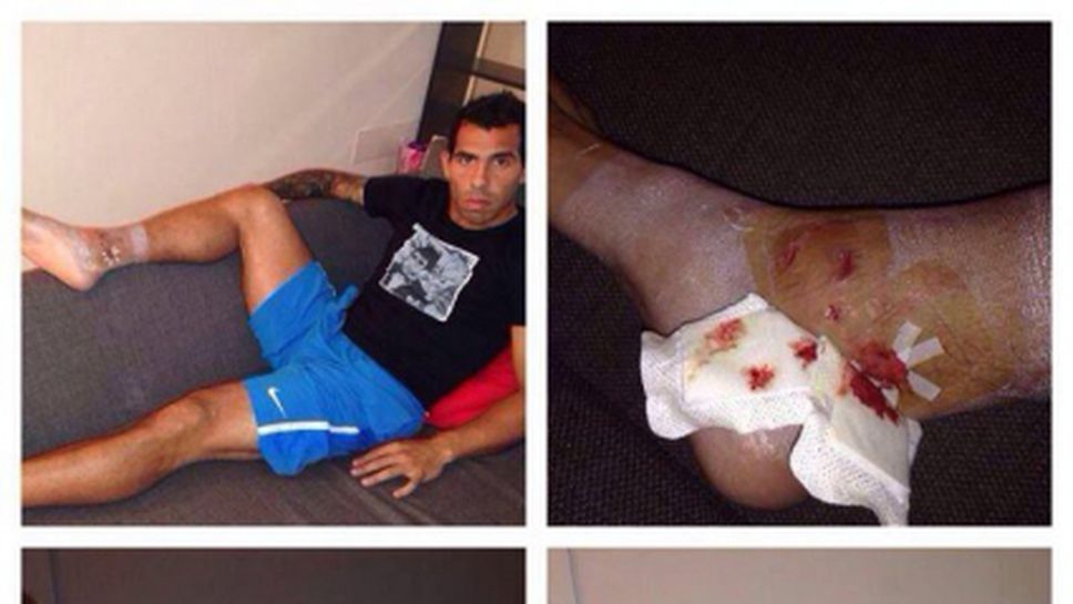 Тевес показа сериозна рана след грубото влизане на Имобиле