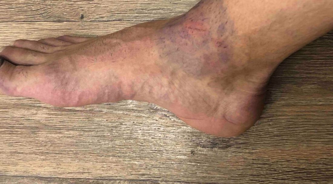 Тежка контузия в Бенковски