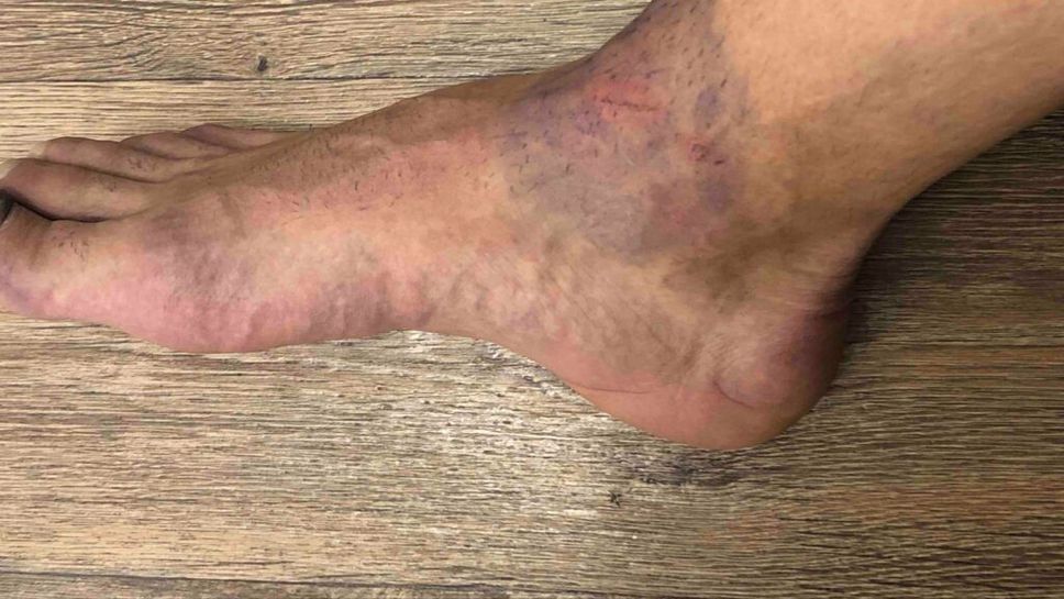 Тежка контузия в Бенковски