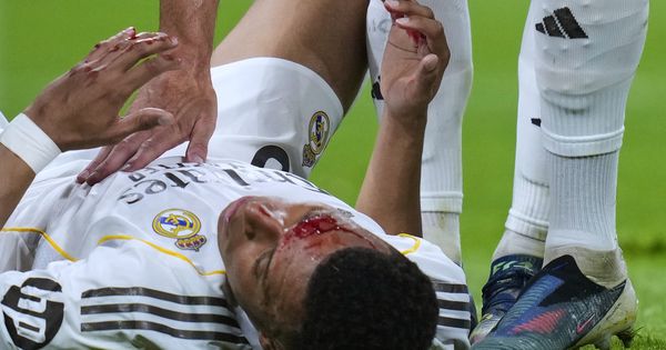 Jeziva povreda, kao da ga je pogodila raketa: Mbape objavio fotografiju posekotine na glavi! /FOTO/