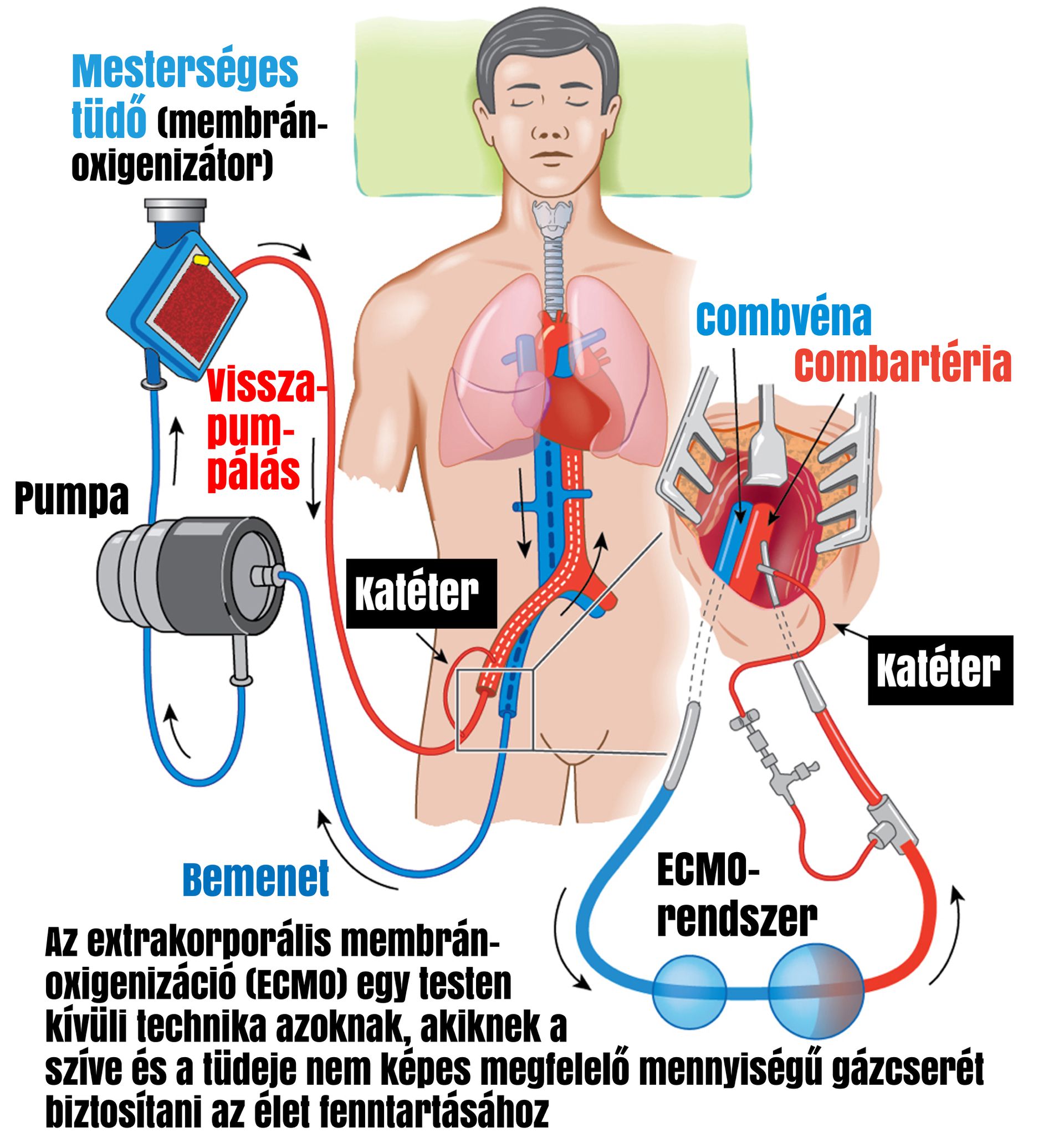 Az ECMO-rendszer a hagyományos lélegeztető helyett a vérben végzi el az oxigén és a szén-dioxid cseréjét /Grafika: Séra Tamás