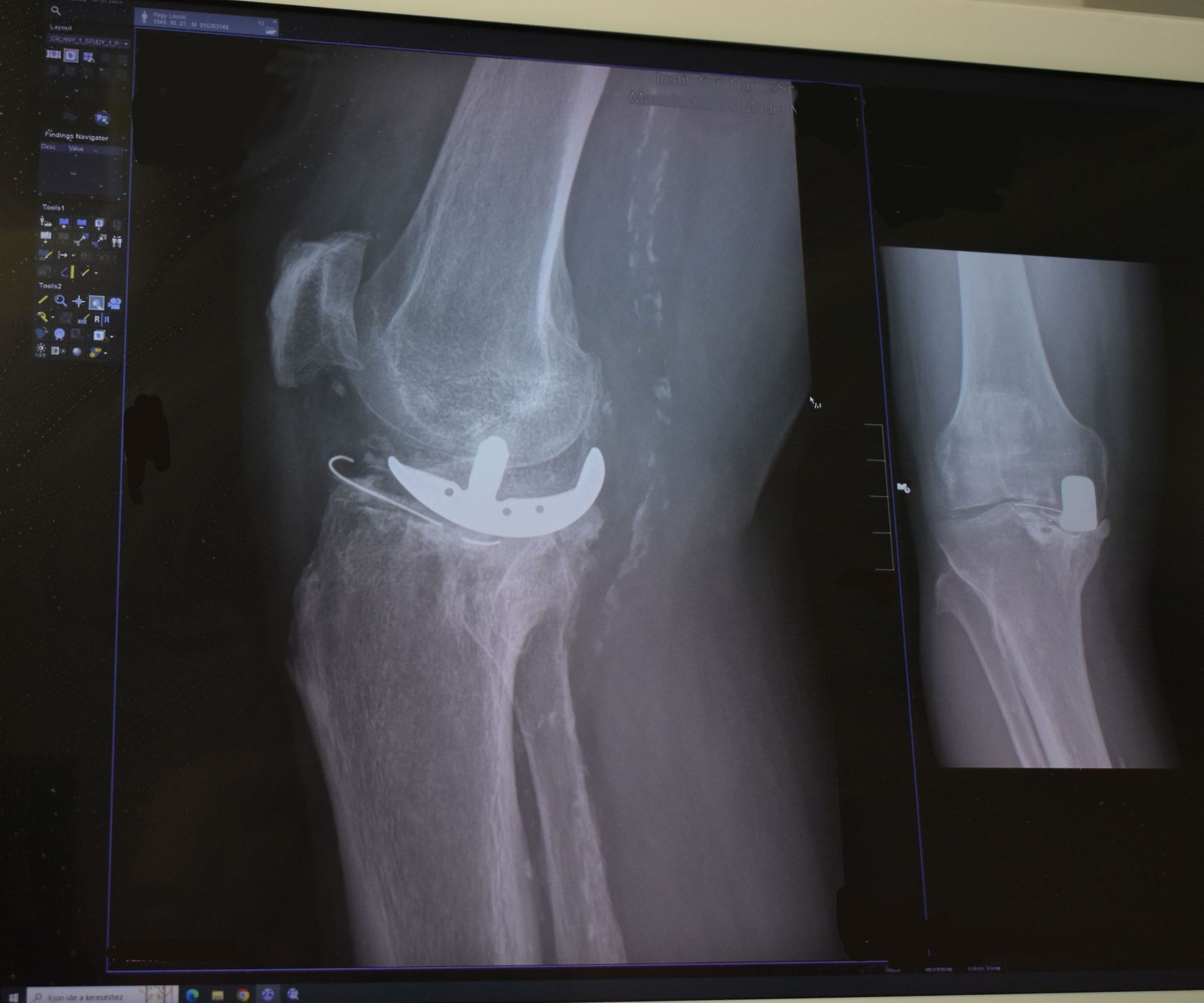 Az olimpiai bajnok jobb lábában lévő régi térdprotézis elhasználódott