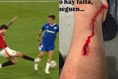 Η εικόνα του ποδιού του Πράντος μετά τη ρεβάνς του «Ολντ Τράφορντ»... σοκάρει (pic)