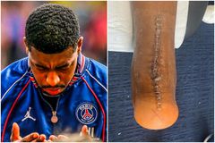 Η ανατριχιαστική φωτογραφία από το χειρουργείο του Κιμπεμπέ