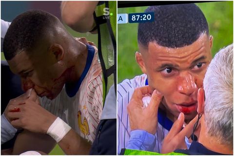 Μάσκες στο ποδόσφαιρο και πώς θα επηρεάσει την όραση του Εμπαπέ μετά τη σπασμένη μύτη του