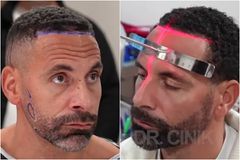 Ο Φέρντιναντ έκανε μεταμόσχευση μαλλιών και γενειάδας: «Επρεπε να γίνει, ήμουν σαν δαλματίας» (vid)