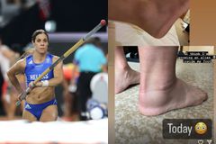 Το πρησμένο πόδι της Στεφανίδη λίγες ώρες μετά τον τραυματισμό της