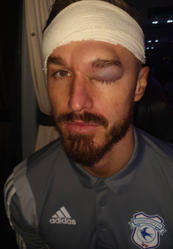 🎥📸 | Cardiff-verdediger showt mega blauw oog na botsing met teamgenoot