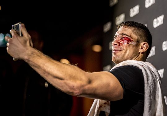 🎥 | Telefoon herkent Rico Verhoeven niet door blauwgeslagen oog