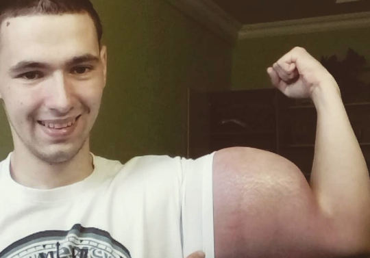 Russische MMA'er met monsterbiceps verliest mogelijk zijn armen: 'Ik ben bang'