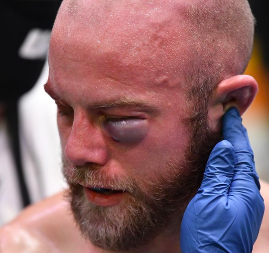 🎥 | Oog UFC'er Justin Jaynes dik en blauw geslagen, doktoren STOPPEN het gevecht