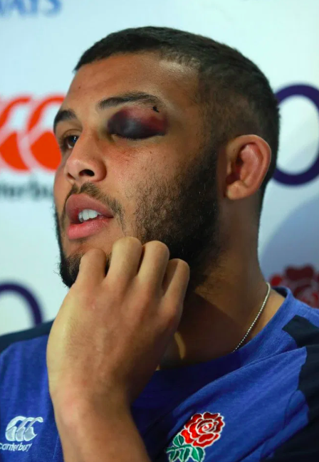 📸 | Engelse rugbyer heeft blauw oog na training, geeft duif de schuld: 'Die beesten zijn wild'