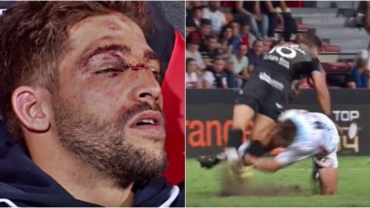 Rugbyspeler krijgt schoen vol in z'n gezicht en loopt misselijke oogblessure op (video)