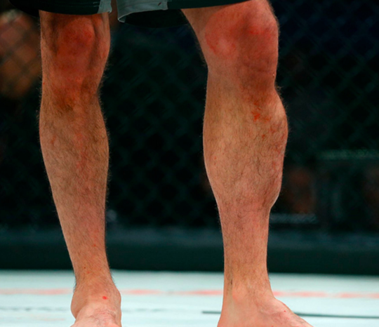 Gehavende MMA'er MacDonald pakt wereldtitel met compleet kapot geschopt been (video)
