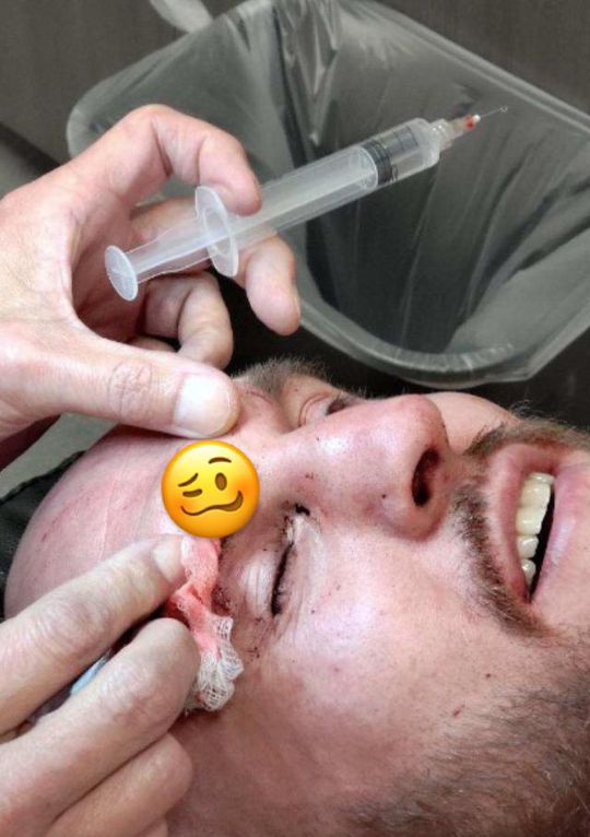 📸 | MMA-sloper Brian Kelleher showt vieze, diepe hoofdwond: 'Past een hotdog in'