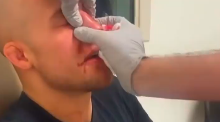 😱 | Zó werd de gebroken neus van MMA-vechter Blake Perry rechtgezet