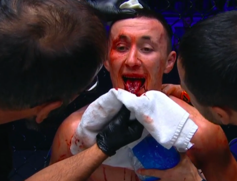 😳 | Dokter stopt MMA-gevecht na bloederige tongblessure bij Albert Misikov