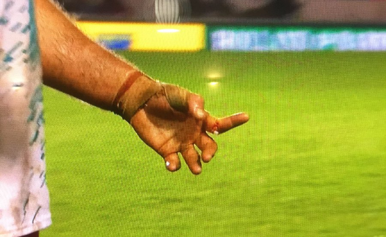 PAS OP: SCHOKKEND! Rugbyspeler breekt vinger (video)