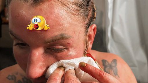 MMA-vechtster showt creepy hoofdwond na bare knuckle gevecht: 'Is maar sneetje'
