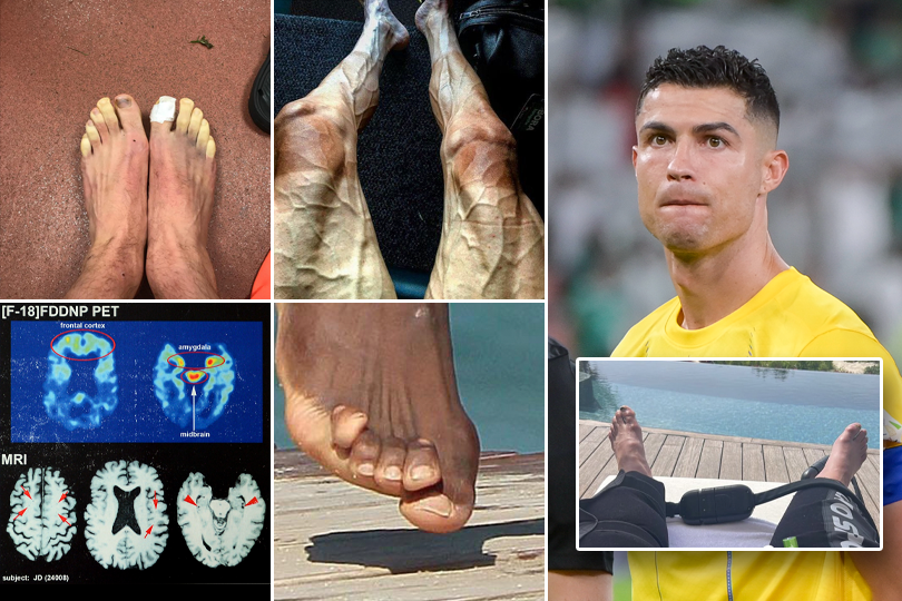De keerzijde van topsport: van opgezwollen enkels en voeten, tot kromme tenen en hersenschade