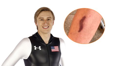 Topschaatser Jordan Stolz laat flink litteken zien: 'Het gaat tot op het bot'