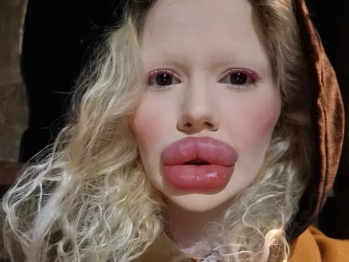 Българското Барби с опасност от некроза и ослепяване: Ще продължа с процедурите въпреки рисковете