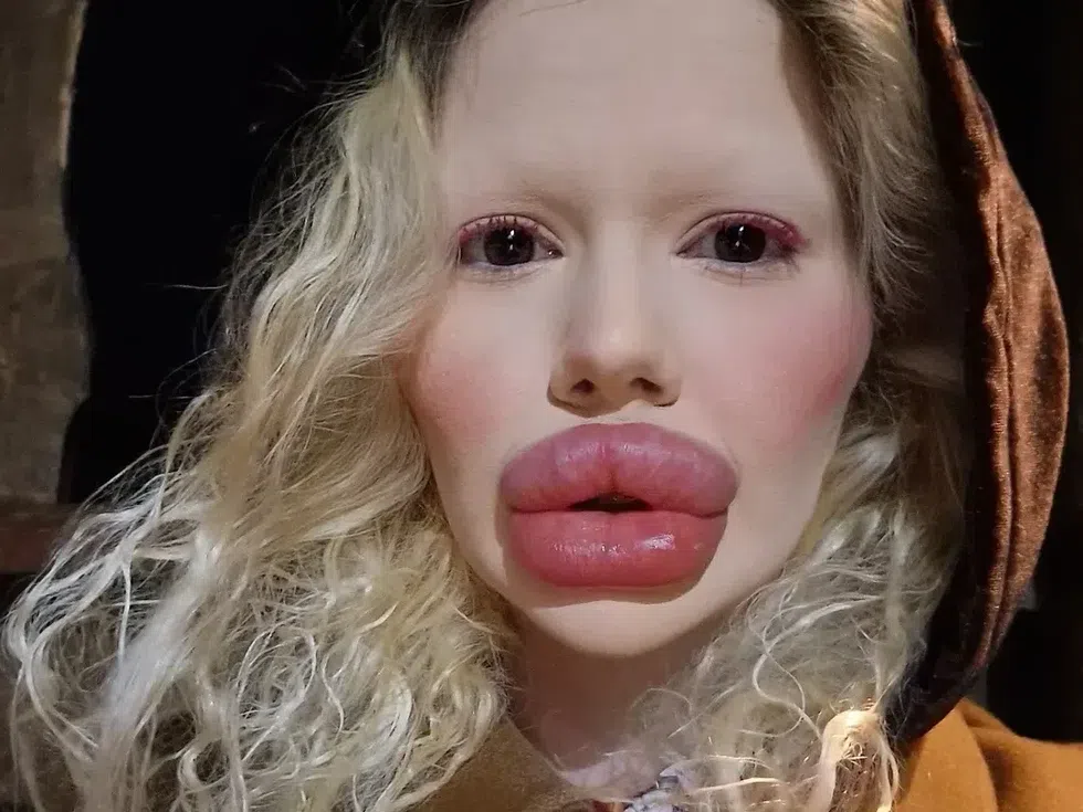 Българското Барби с опасност от некроза и ослепяване: Ще продължа с процедурите въпреки рисковете