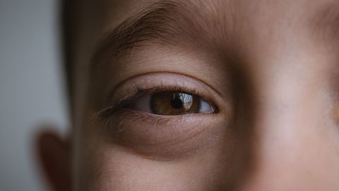 Снежна слепота за което техническият термин е фотокератит причинява болка