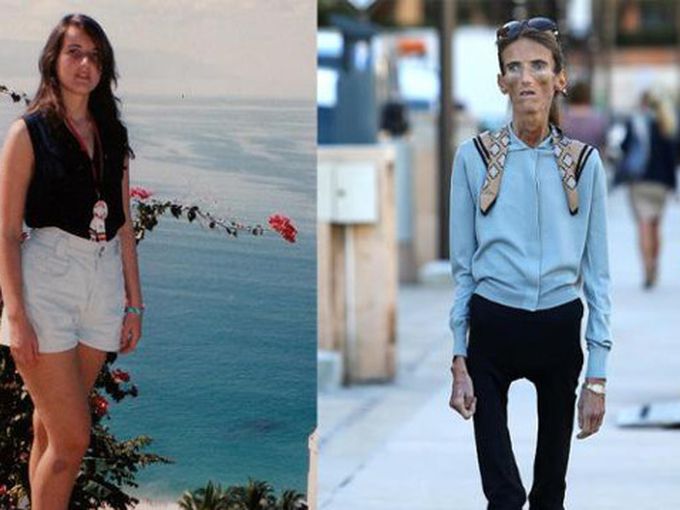 Шокиращата история на анорексичката Валерия Левитин