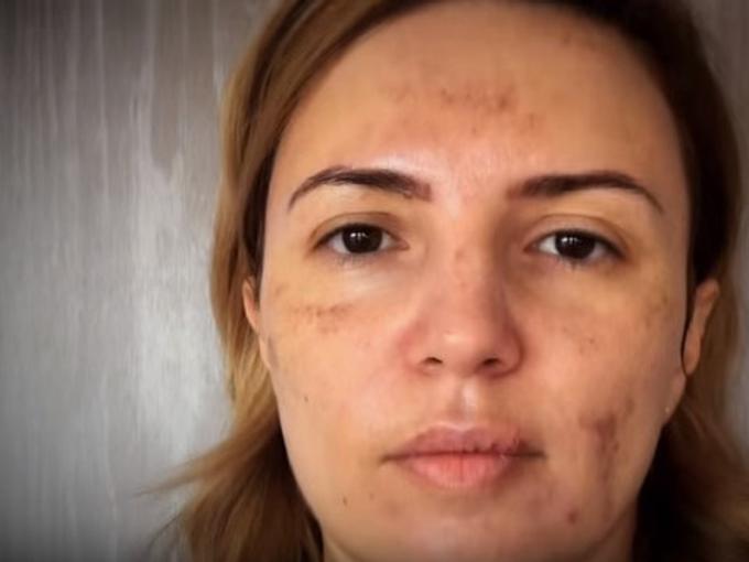 Вижте Ирина Тенчева след химическия пилинг