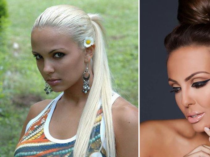 Пластичните операции на Николета Лозанова