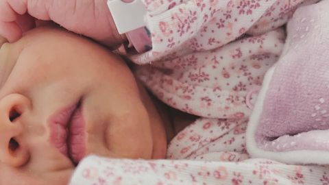 Генетичното заболяване ихтиоза наричано още плод Арлекин се забелязва още