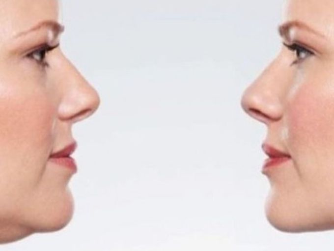 Как да се избавим от двойната брадичка