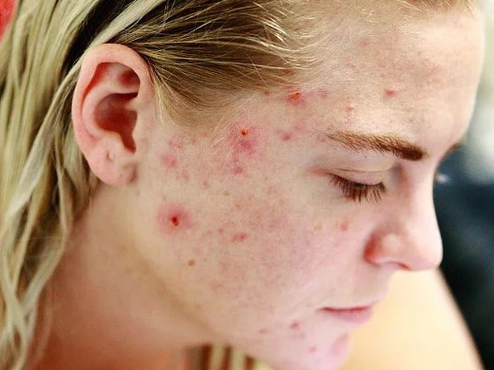 Лазер заличава акне и прави вагинален лифтинг