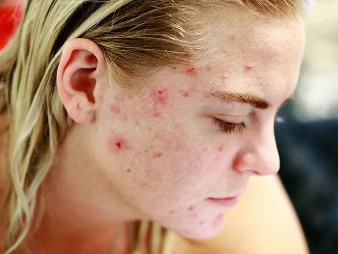 Безплатни прегледи за акне в края на октомври