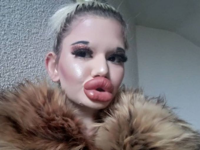 Българското Барби си подари 27-ата инжекция с хиалурон (снимки)